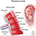 Placenta Accreta